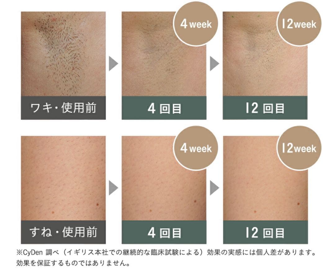 脱毛・除毛 pure adapt SMOOTHSKIN