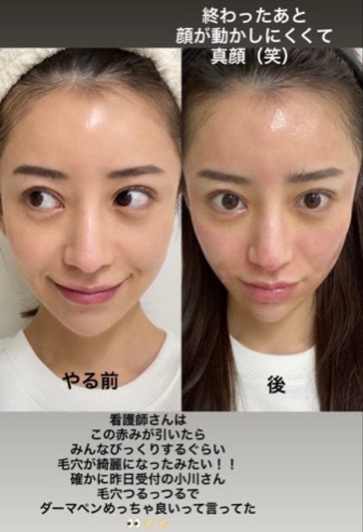 おまけ付❇️リジェンスキンSRSシートパック❇️成長因子幹細胞たっぷり配合✨美肌へ✨