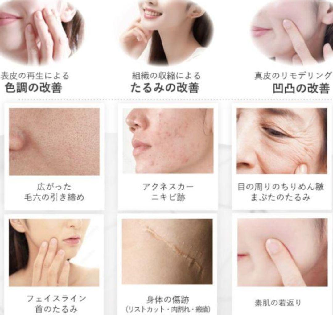 tria 美容 家庭用シミ取りレーザー　肝斑　ニキビ跡　色素沈着　毛穴開き　美白