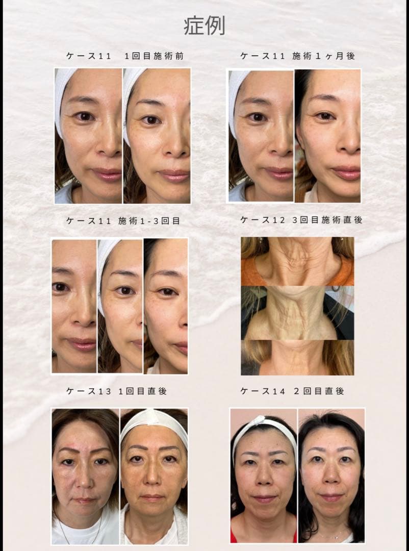 ジェットプラズマ美品