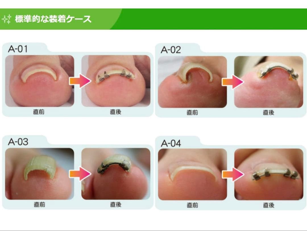 まき爪リフト　4個セット【正規品】